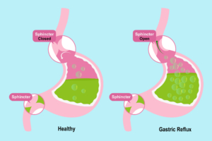 A diagram of a healthy and an unhealthy acid reflux gastric system