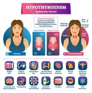 An infographic of hypothyroidism symptoms with cartoon renderings of a normal and an abnormal thyroid gland with explanatory text below