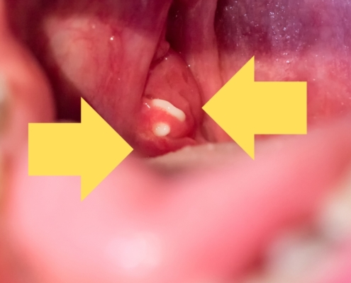 An image of swollen tonsils.