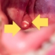 An image of swollen tonsils