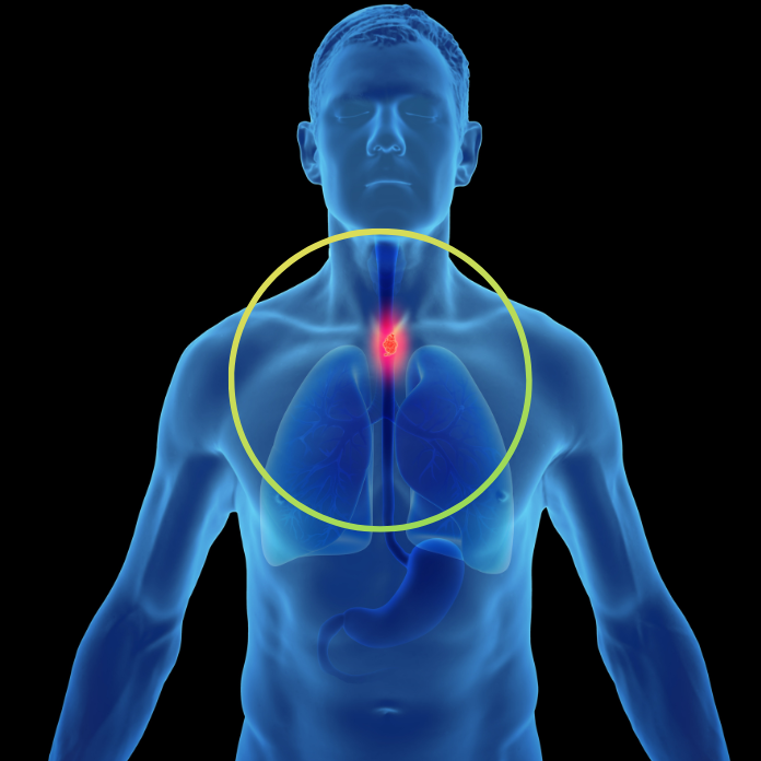 Throat Cancer Symptoms Causes Diagnosis Treatment